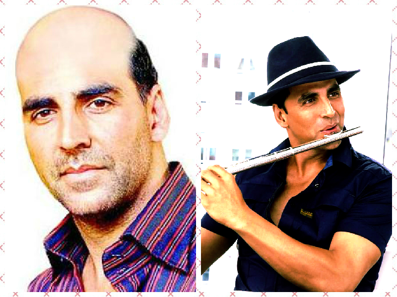 Bollywood Stars Who are Bald and Went for Hair Transplants