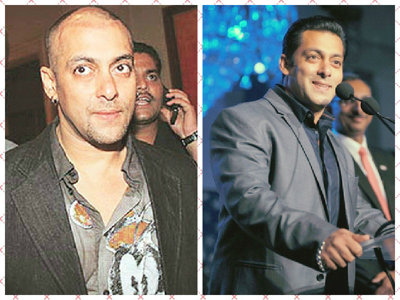 Bollywood Stars Who are Bald and Went for Hair Transplants
